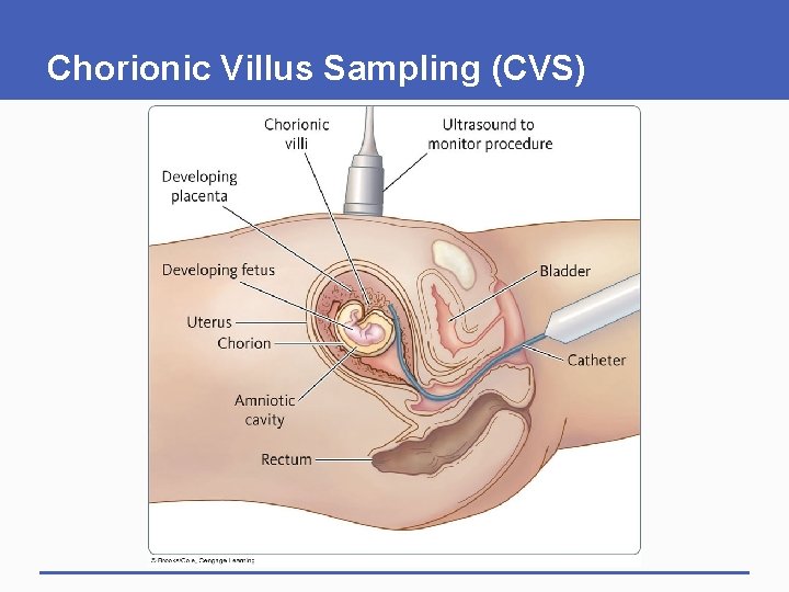Chorionic Villus Sampling (CVS) 