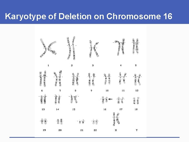 Karyotype of Deletion on Chromosome 16 