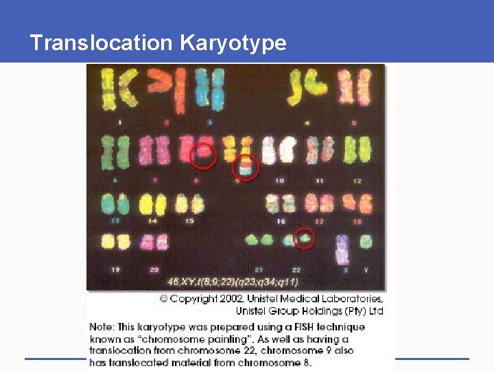 Translocation Karyotype 