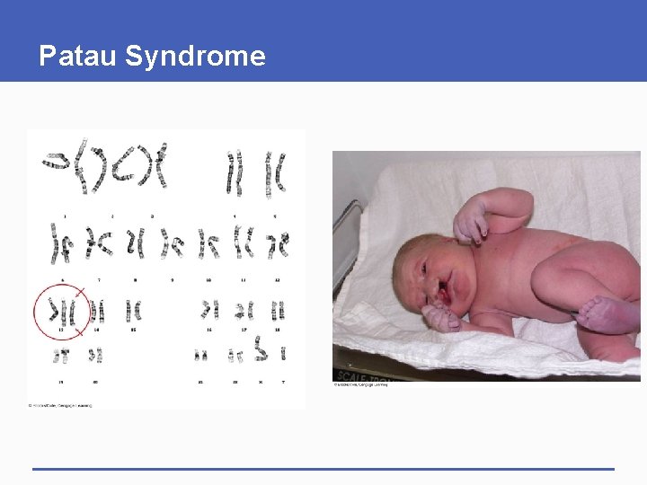 Patau Syndrome 