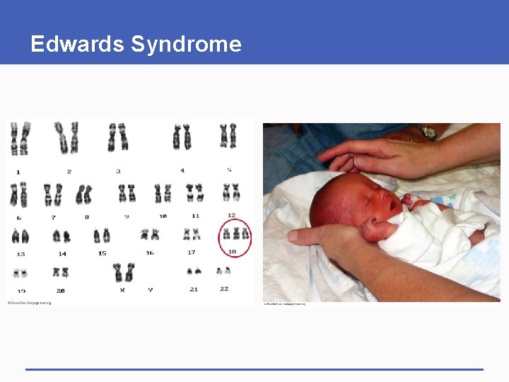 Edwards Syndrome 