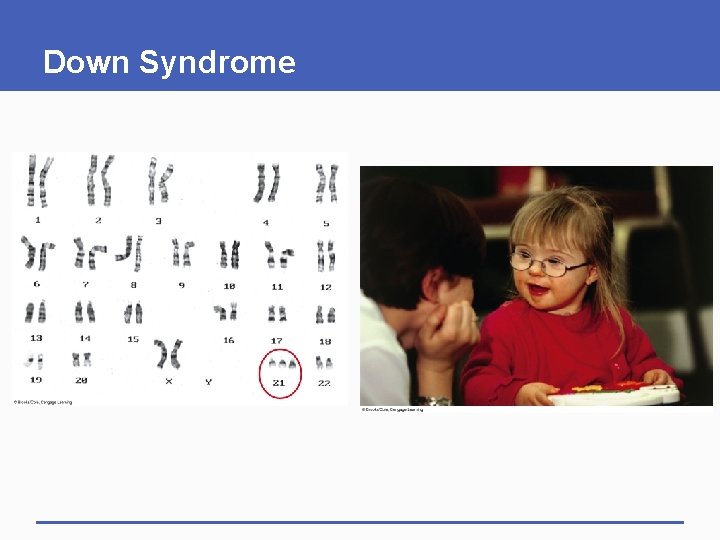 Down Syndrome 