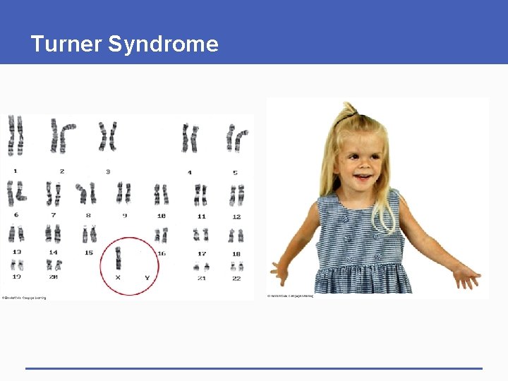Turner Syndrome 
