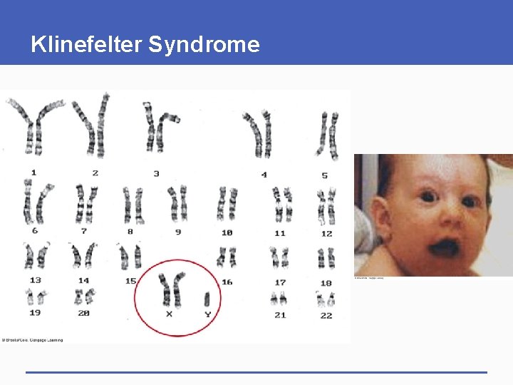 Klinefelter Syndrome 