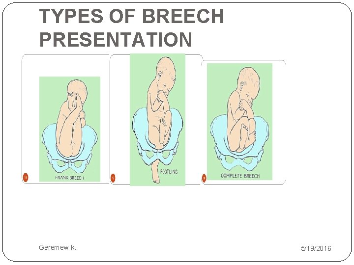 TYPES OF BREECH PRESENTATION Geremew k. 5/19/2016 