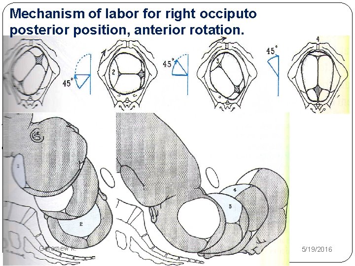 Mechanism of labor for right occiputo posterior position, anterior rotation. , 0 Geremew k.