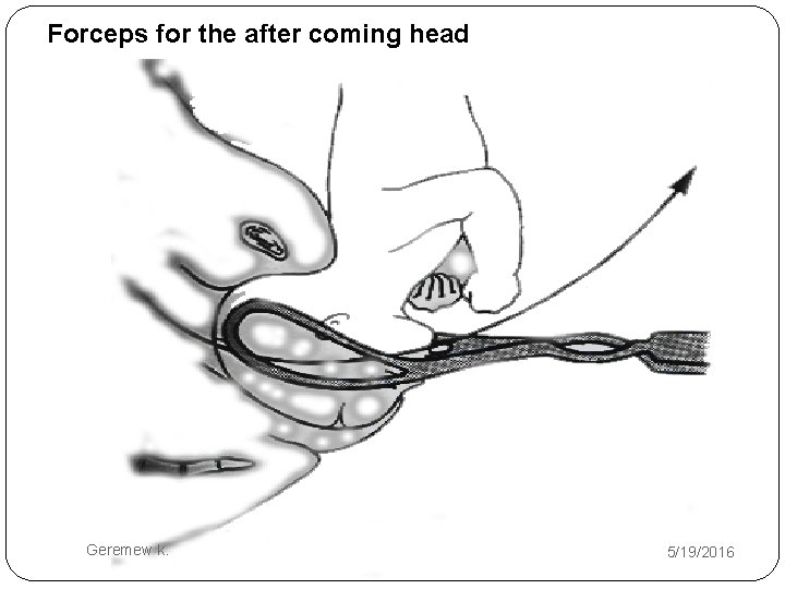 Forceps for the after coming head Geremew k. 5/19/2016 