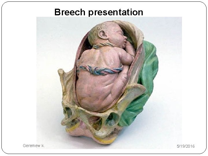 Breech presentation Geremew k. 5/19/2016 