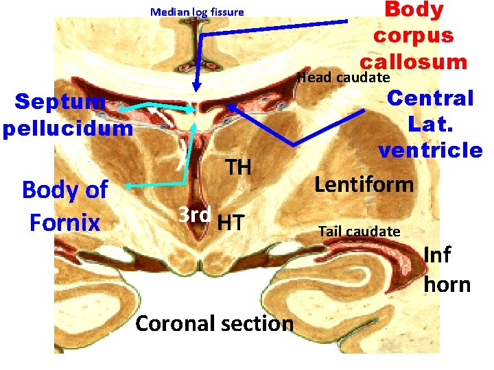 Median log fissure Head caudate Septum pellucidum Body of Fornix Body corpus callosum TH