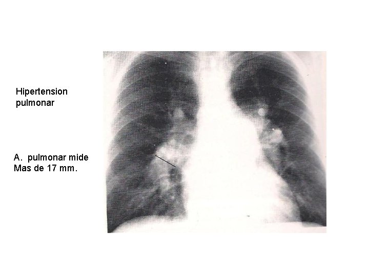 Hipertension pulmonar A. pulmonar mide Mas de 17 mm. 