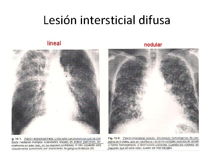 Lesión intersticial difusa lineal nodular 