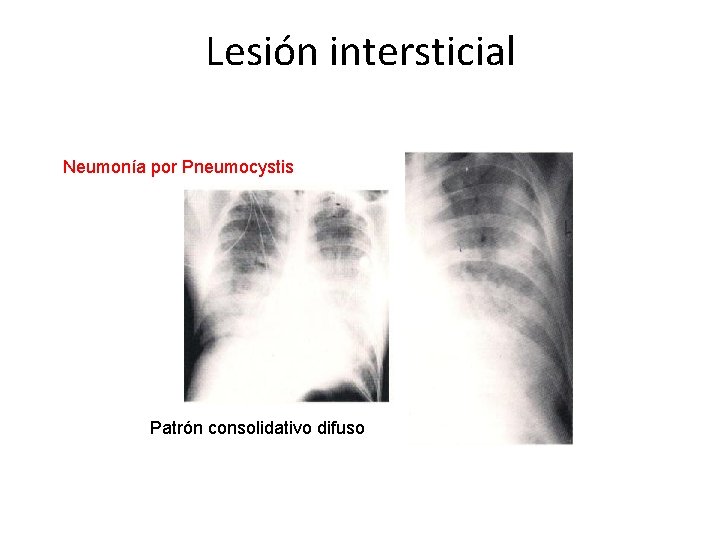 Lesión intersticial Neumonía por Pneumocystis Patrón consolidativo difuso 