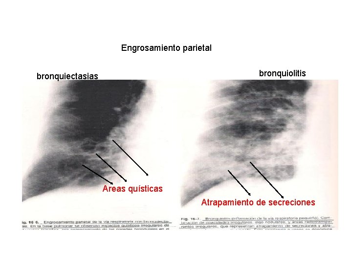 Engrosamiento parietal bronquiolitis bronquiectasias Areas quísticas Atrapamiento de secreciones 