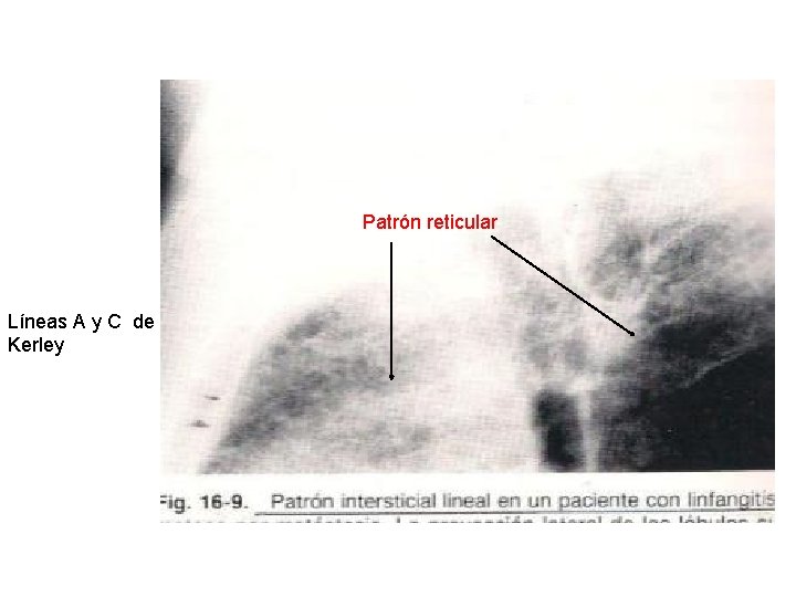 Patrón reticular Líneas A y C de Kerley 