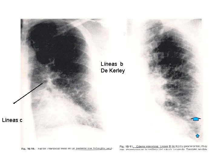 Líneas b De Kerley Lineas c 