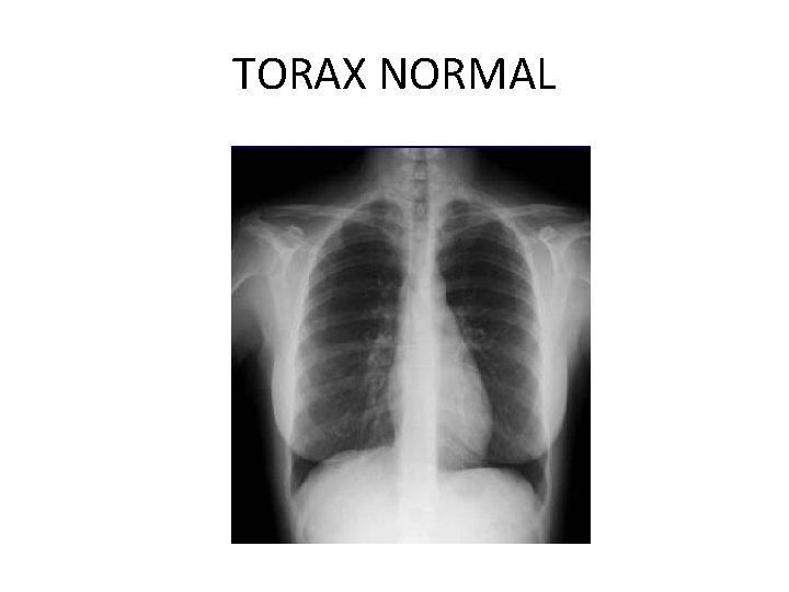 TORAX NORMAL 