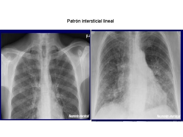 Patrón intersticial lineal 