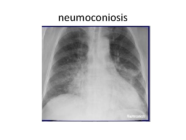 neumoconiosis 