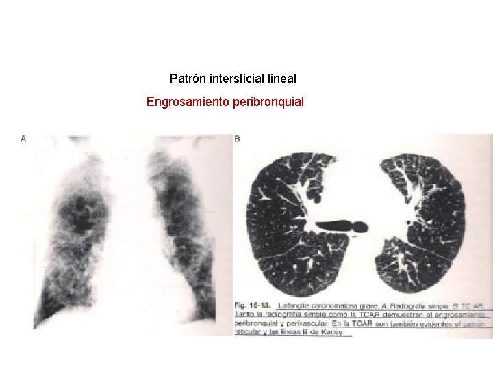 Patrón intersticial lineal Engrosamiento peribronquial 