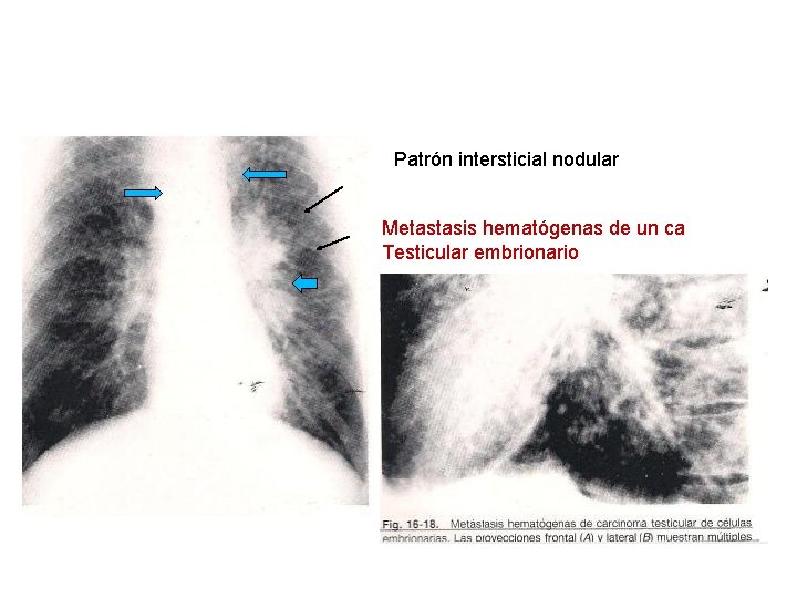 Patrón intersticial nodular Metastasis hematógenas de un ca Testicular embrionario 
