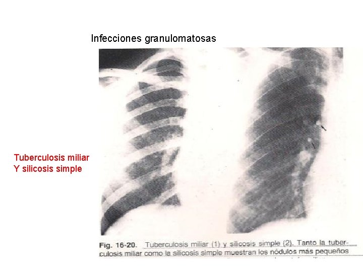 Infecciones granulomatosas Tuberculosis miliar Y silicosis simple 