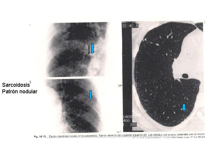 Sarcoidosis Patrón nodular 