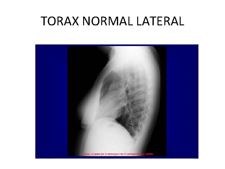 TORAX NORMAL LATERAL 