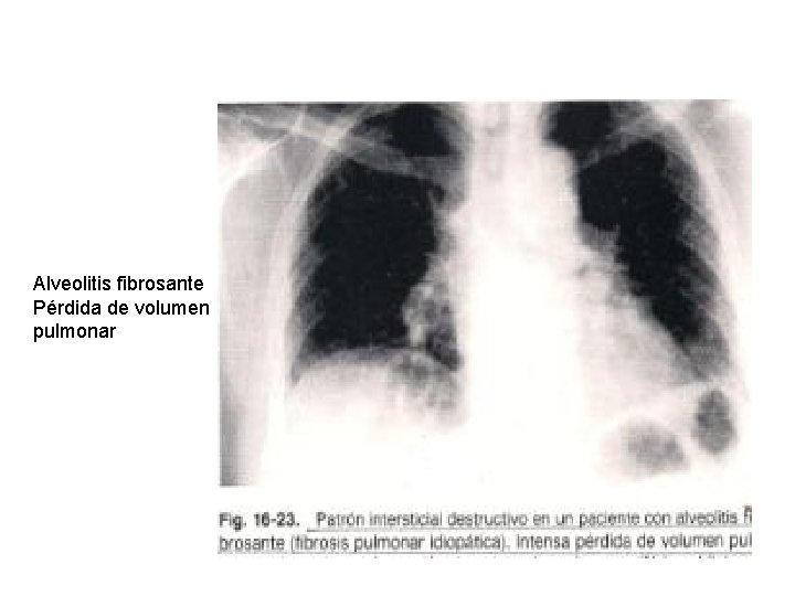 Alveolitis fibrosante Pérdida de volumen pulmonar 