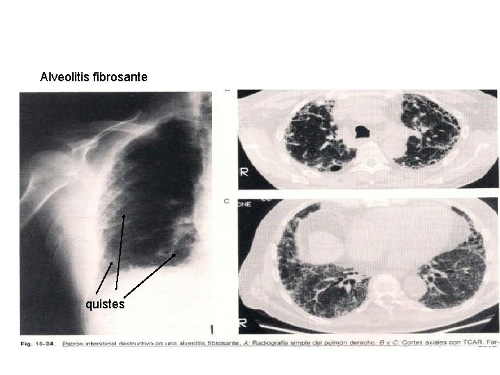 Alveolitis fibrosante quistes 