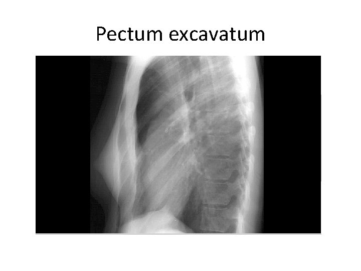 Pectum excavatum 