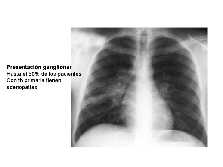 Presentación ganglionar Hasta el 90% de los pacientes Con tb primaria tienen adenopatías 