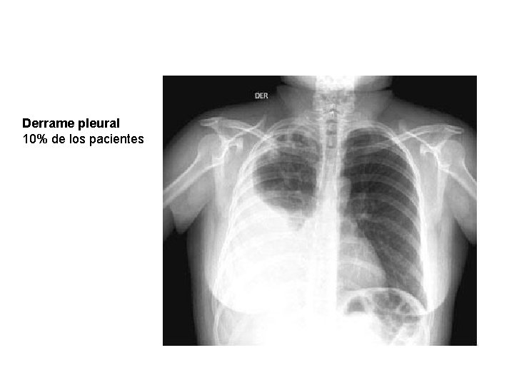 Derrame pleural 10% de los pacientes 