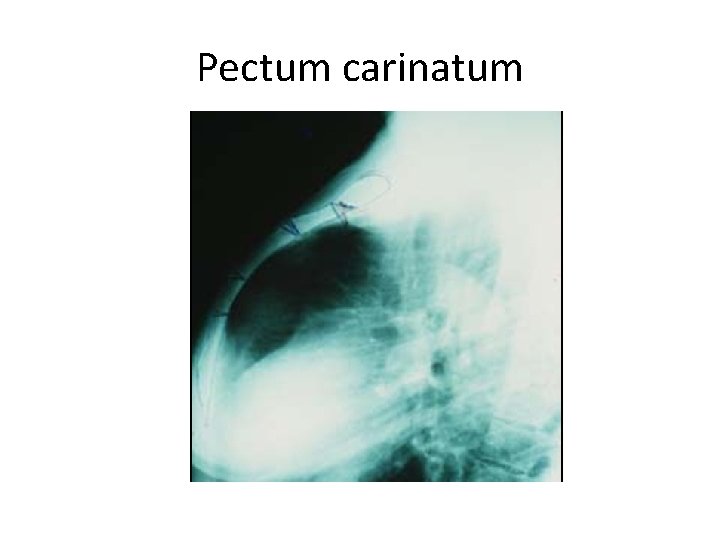 Pectum carinatum 