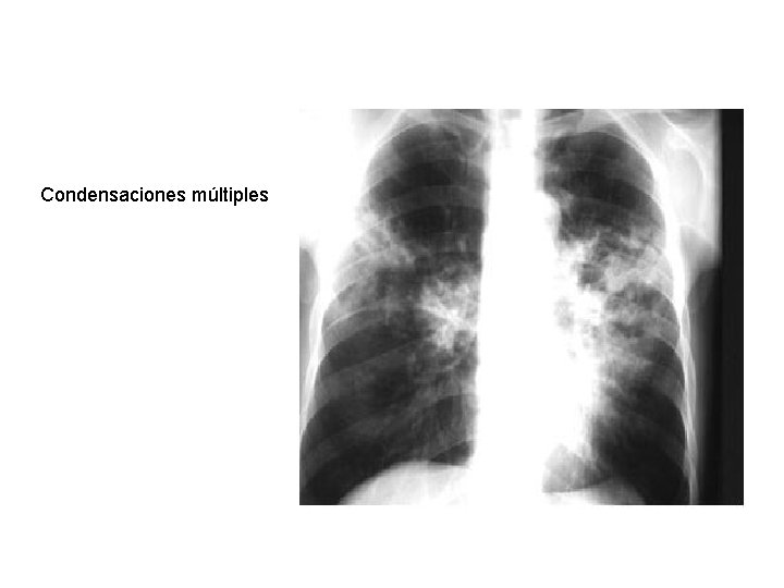 Condensaciones múltiples 