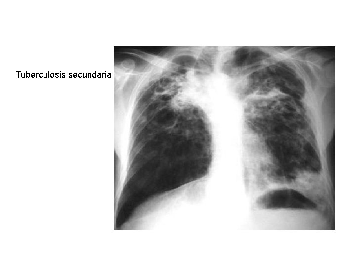 Tuberculosis secundaria 