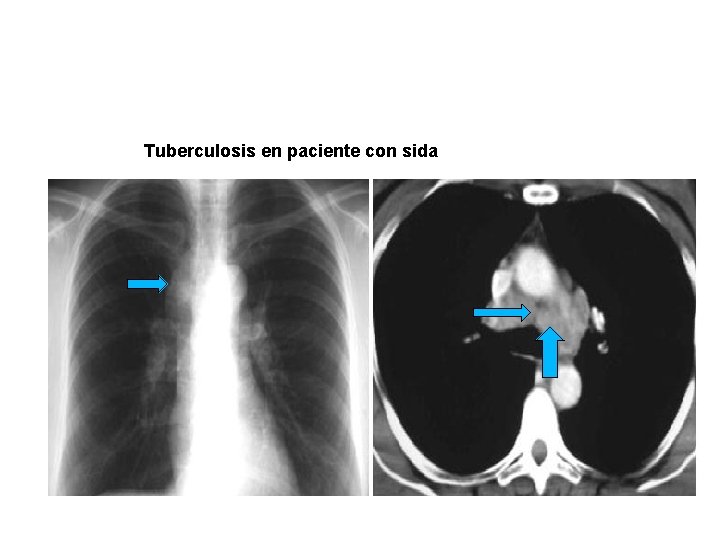 Tuberculosis en paciente con sida 