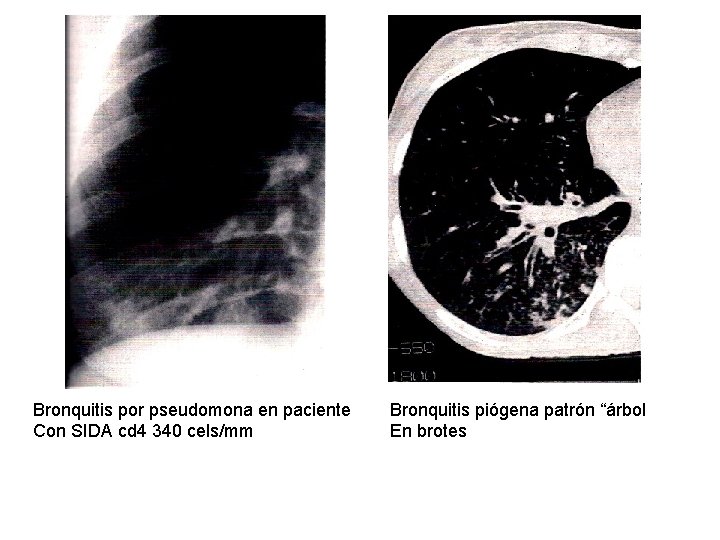 Bronquitis por pseudomona en paciente Con SIDA cd 4 340 cels/mm Bronquitis piógena patrón