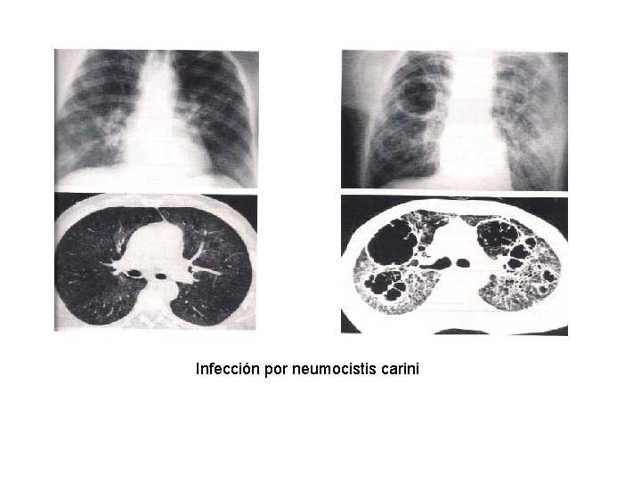 Infección por neumocistis carini 