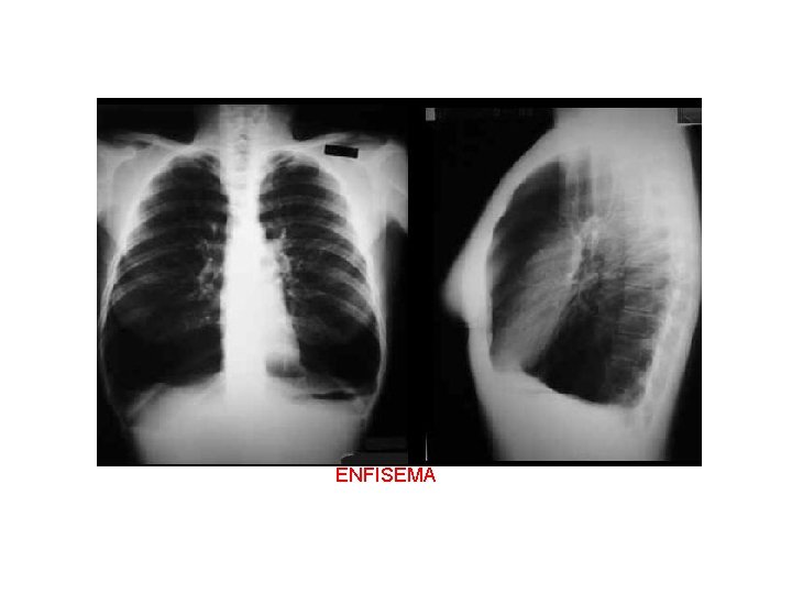 ENFISEMA 