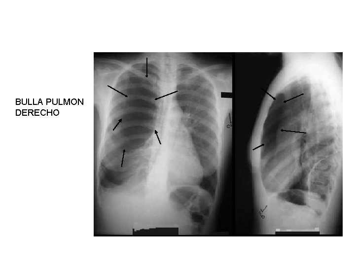 BULLA PULMON DERECHO 