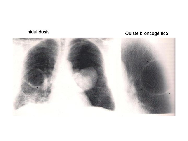 hidatidosis Quiste broncogénico 