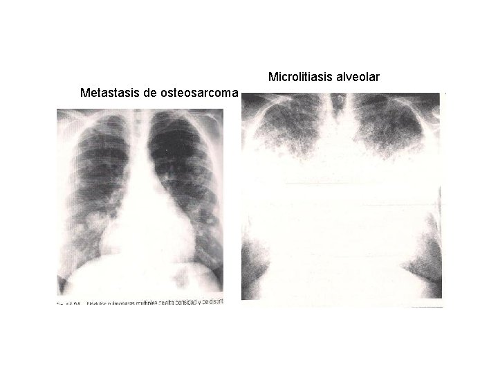 Microlitiasis alveolar Metastasis de osteosarcoma 