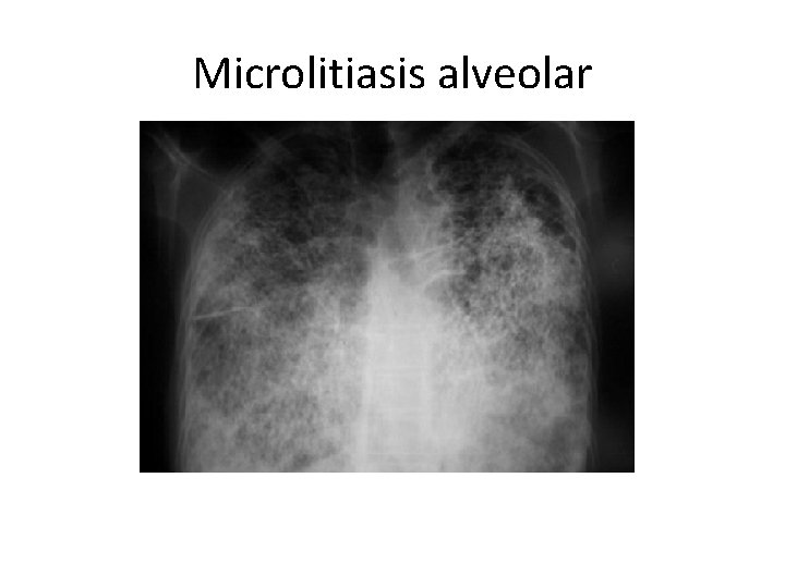 Microlitiasis alveolar 