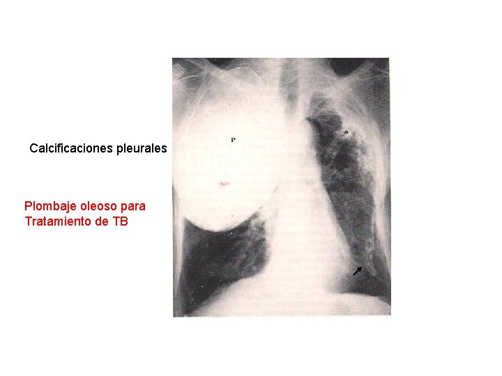 Calcificaciones pleurales Plombaje oleoso para Tratamiento de TB 