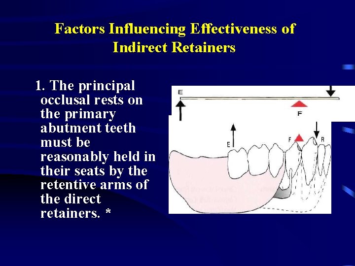 Factors Influencing Effectiveness of Indirect Retainers 1. The principal occlusal rests on the primary