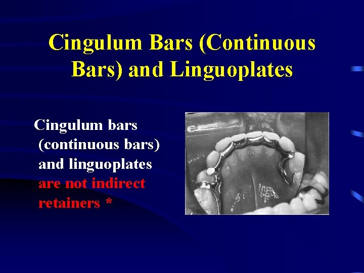 Cingulum Bars (Continuous Bars) and Linguoplates Cingulum bars (continuous bars) and linguoplates are not