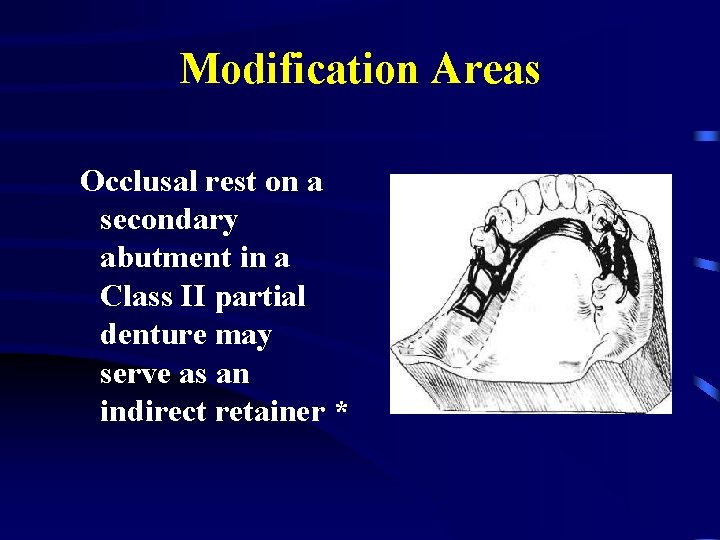 Modification Areas Occlusal rest on a secondary abutment in a Class II partial denture