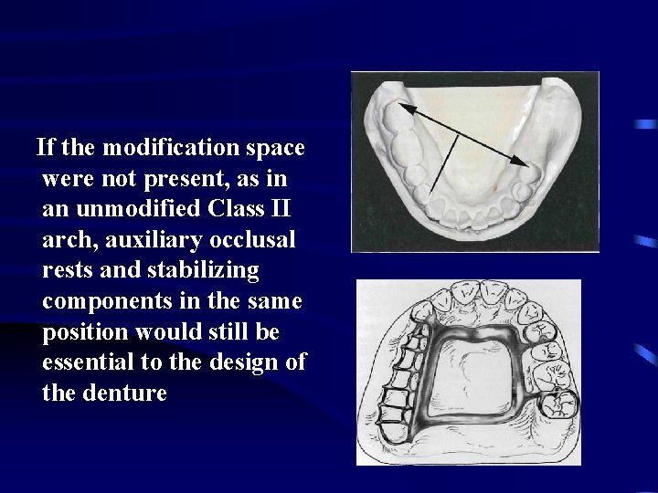 If the modification space were not present, as in an unmodified Class II arch,