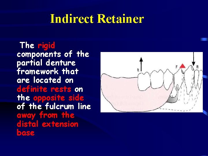 Indirect Retainer The rigid components of the partial denture framework that are located on