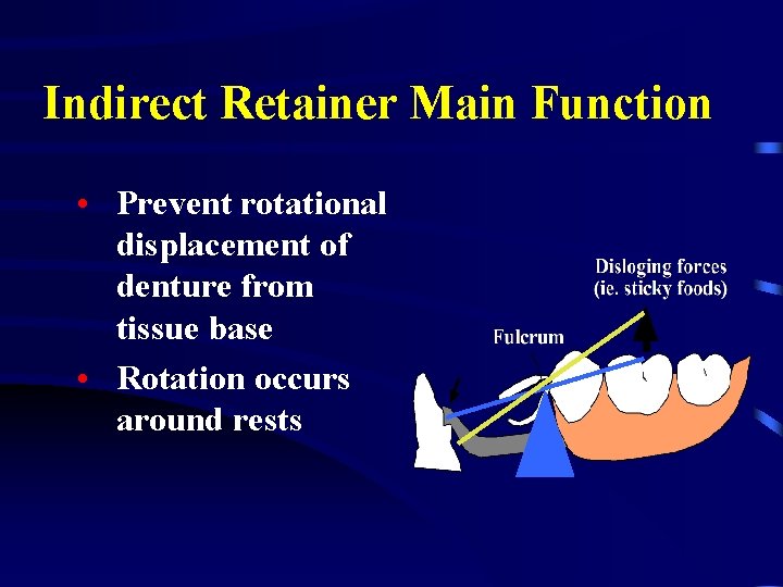 Indirect Retainer Main Function • Prevent rotational displacement of denture from tissue base •